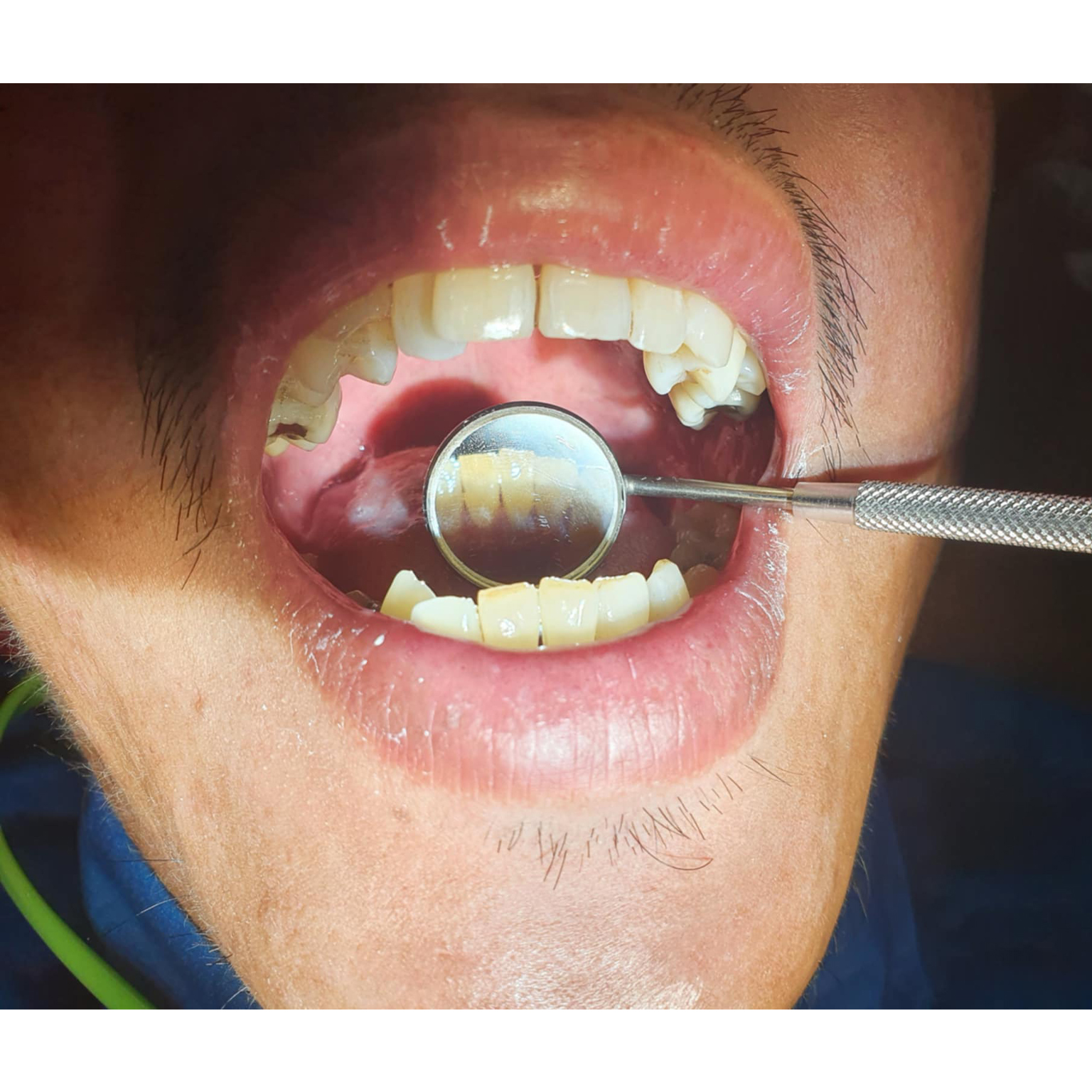 Oral Prophylaxis and Deep Cleaning