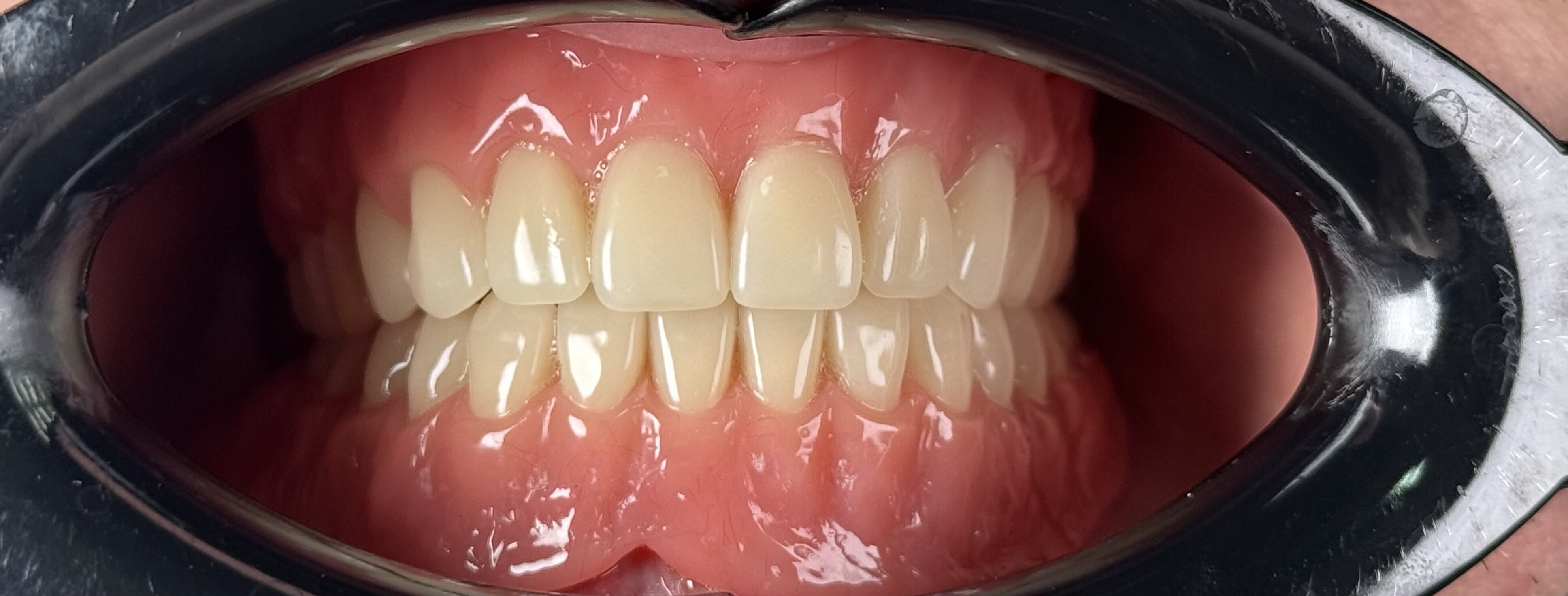 Removable Dentures