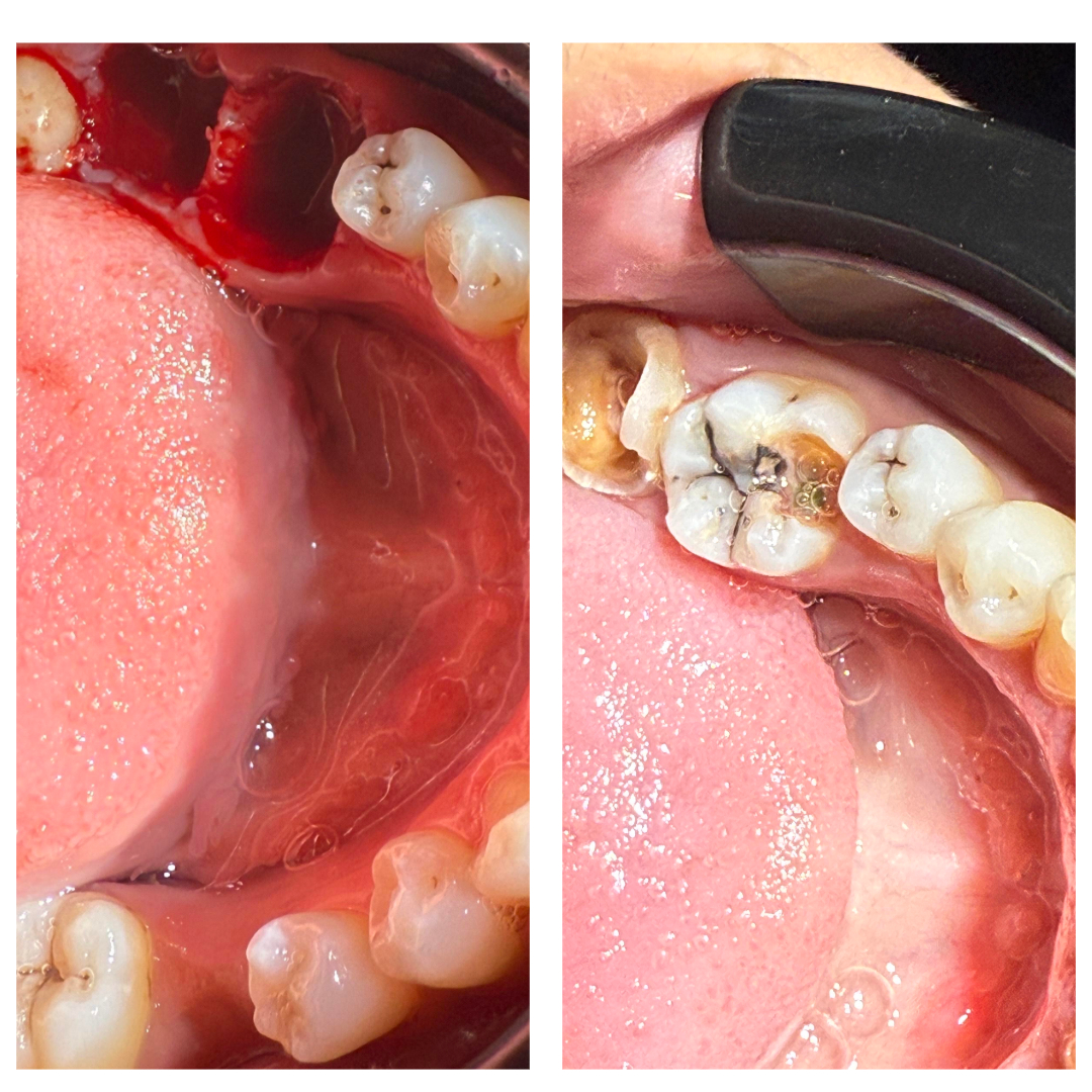 Tooth Extraction