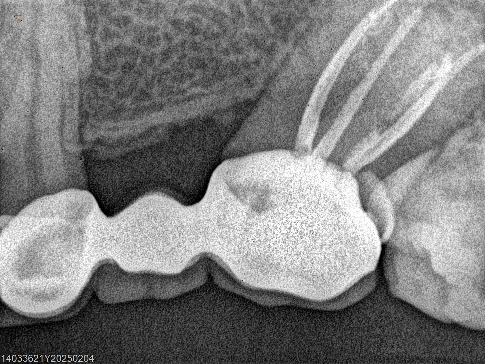 Root Canal Treatment