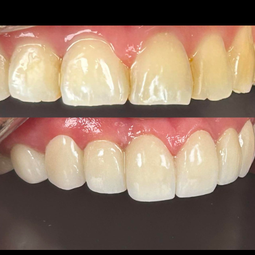 Veneers