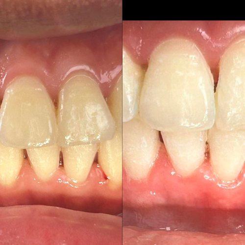 Oral Whitening