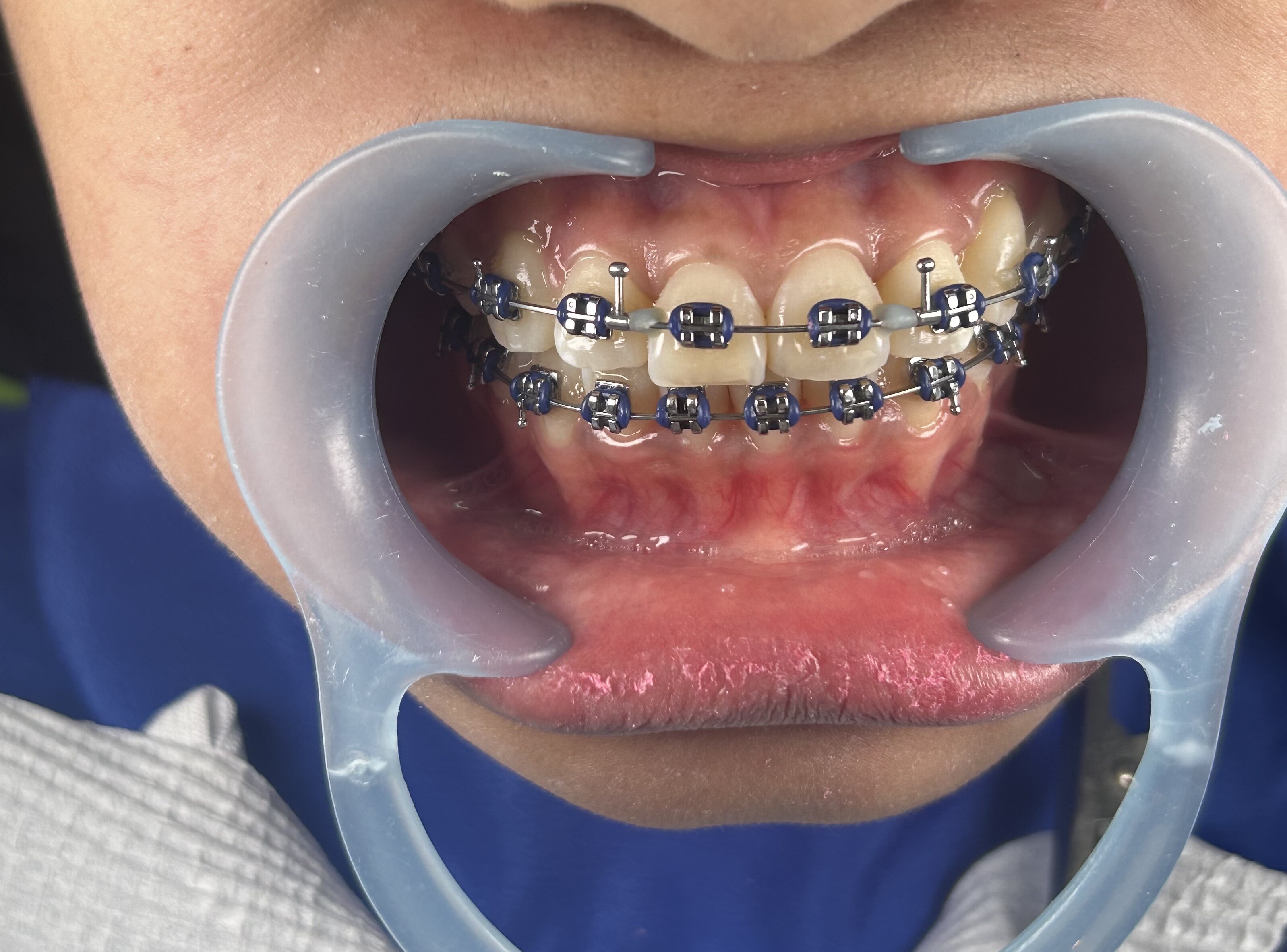 Orthodontic Treatment